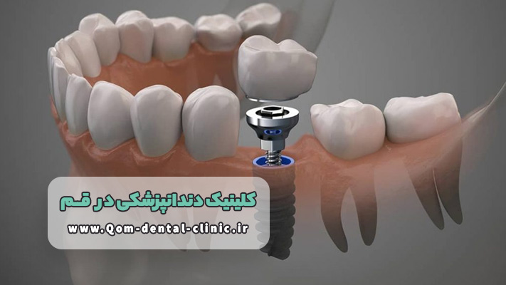 نصب ایمپلنت دندان در کلینیک دندانپزشکی قم